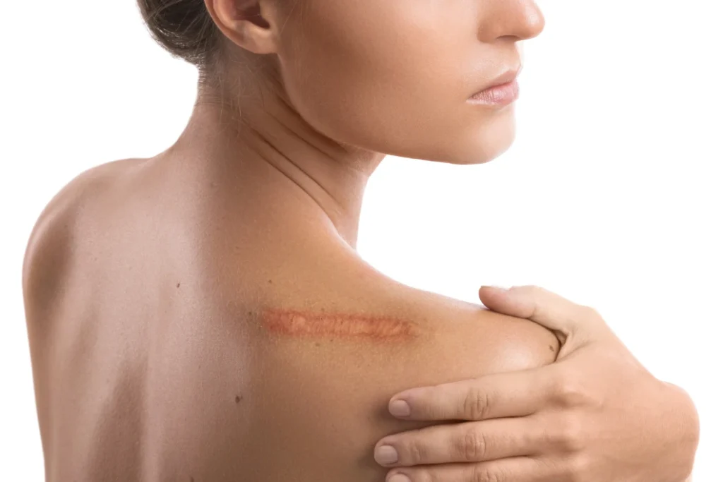 RR Skin and Aesthetics Scars in Pinecrest, FL