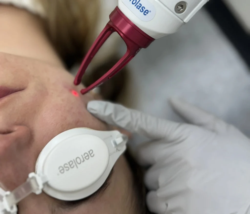 R&R Skin and Aesthetics Aerolase Laser Treatment in Pinecrest, FL