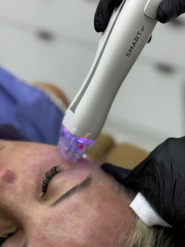 R&R Skin and Aesthetics Microneedling in Pinecrest, FL