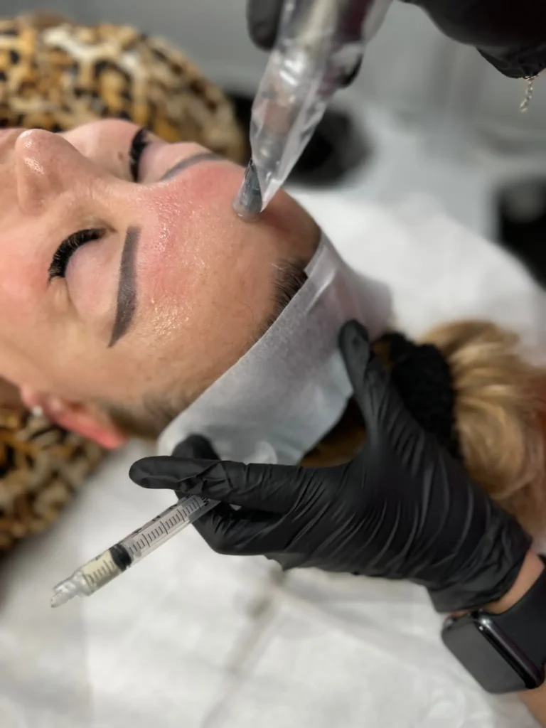 R&R Skin and Aesthetics Microneedlings Treatment in Pinecrest, FL