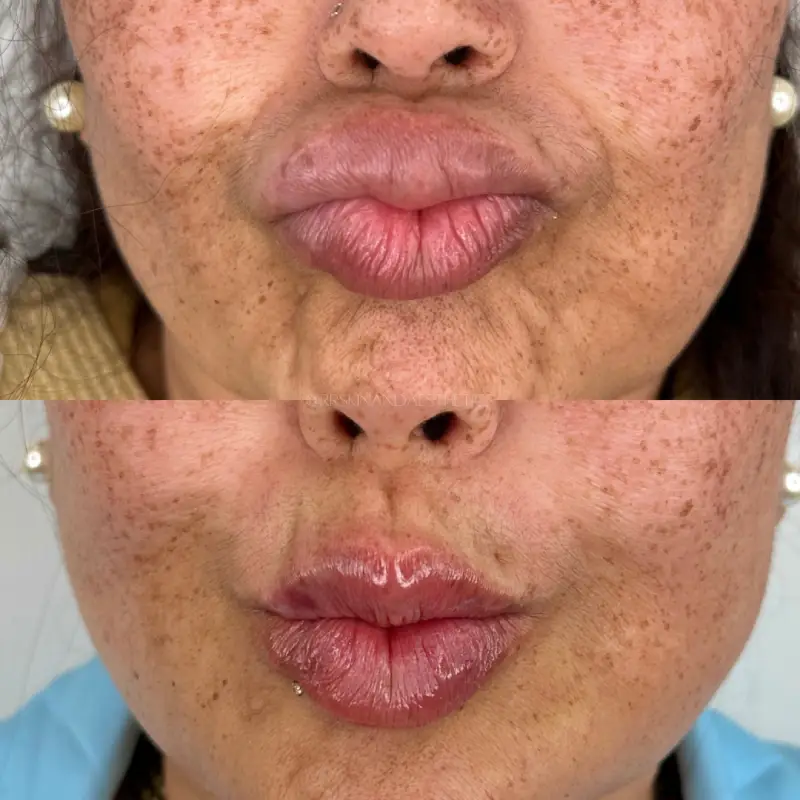 RR-Skin-and-Aesthetics_Before-After-dissolve-refill-lip-a-in-Pinecrest-FL