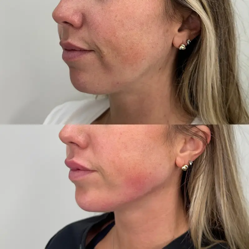 RR-Skin-and-Aesthetics_Before-After-jawline-chin-filler-a-in-Pinecrest-FL