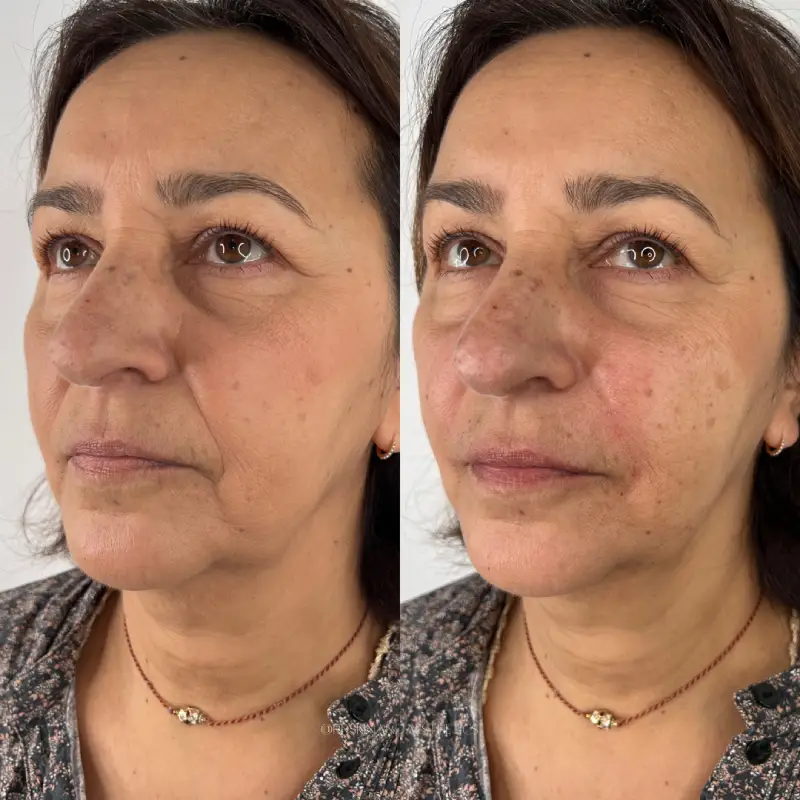 RR-Skin-and-Aesthetics_Before-After-smile-line-filler-a-in-Pinecrest-FL