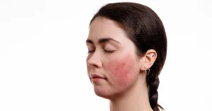 Acne Treatments in Pinecrest, FL