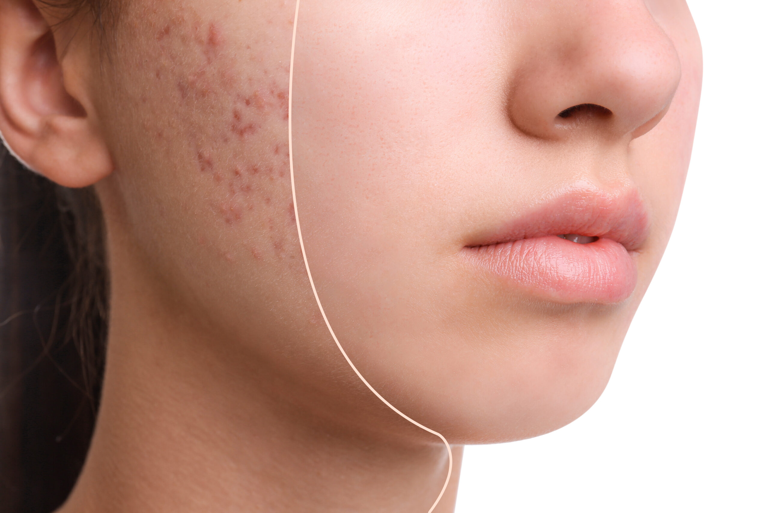 Effective Acne Treatments at R&R Skin & Aesthetics, Pinecrest