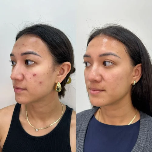 R&R Skin and Aesthetics Acne Treatments Before After A in Pinecrest, FL
