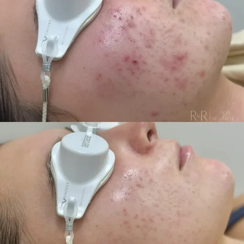 R&R Skin and Aesthetics Acne Treatments Before After B in Pinecrest, FL