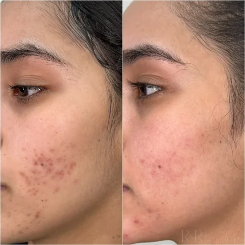 R&R Skin and Aesthetics Acne Treatments Before After C in Pinecrest, FL