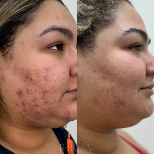 R&R Skin and Aesthetics Acne Treatments Before After D in Pinecrest, FL