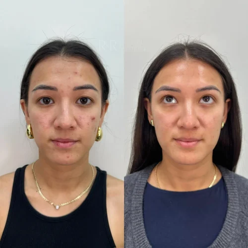 R&R Skin and Aesthetics Acne Treatments Before After E in Pinecrest, FL