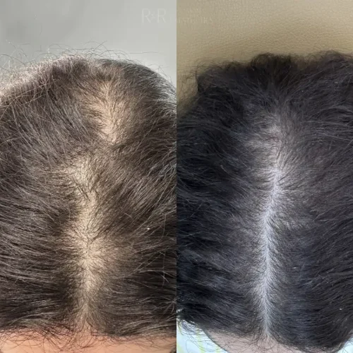RR Skin and Aesthetics Before After prp hair in Pinecrest, FL
