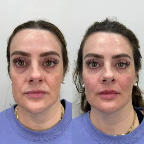 RR Skin and Aesthetics Before After sculptra a in Pinecrest, FL